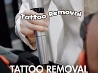 New Laser Tattoo removal