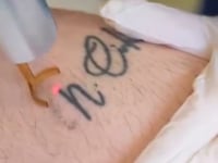 New Laser Tattoo removal
