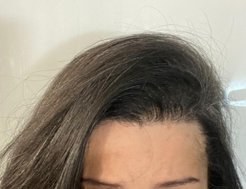 Hair regrowth