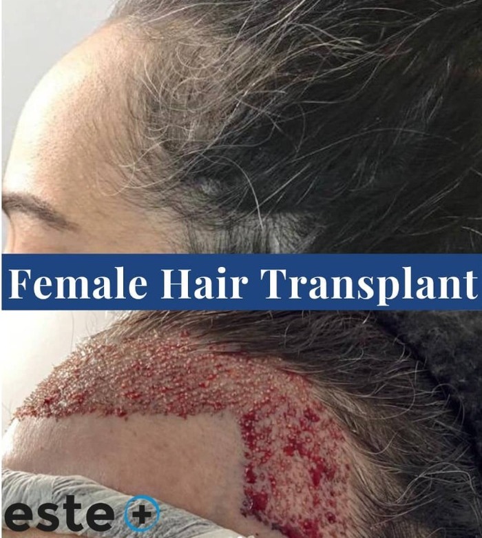 Female Hair Transplant