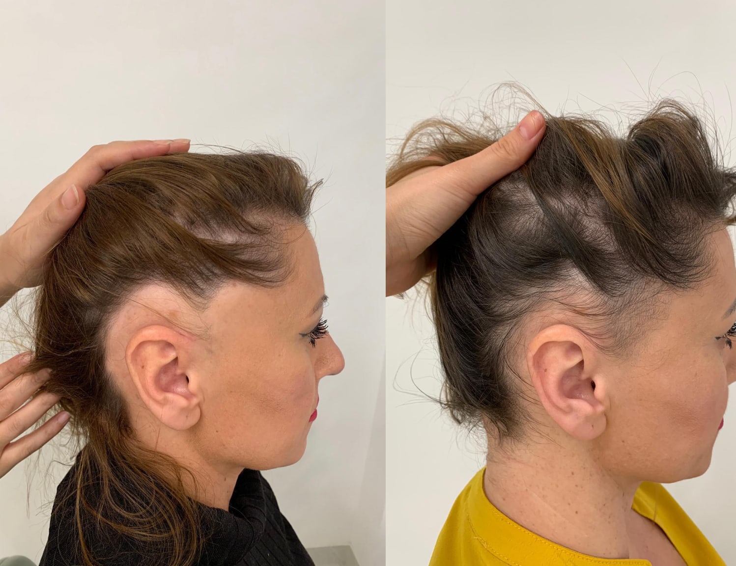 Hair loss for women results