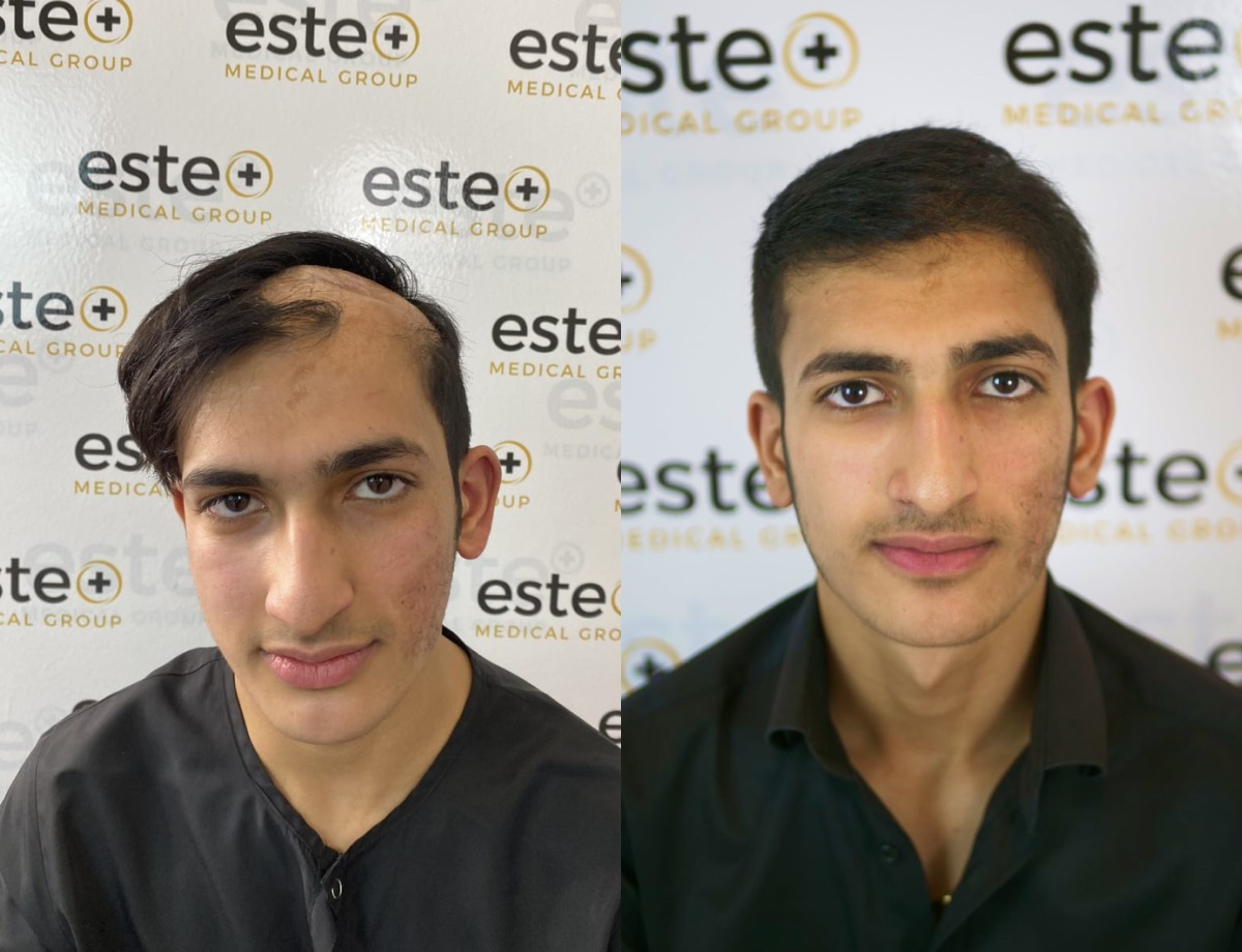 Before After