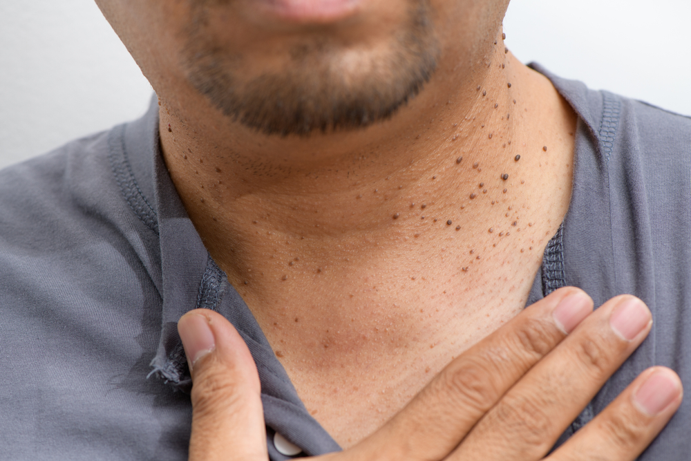 chemical peel before and after