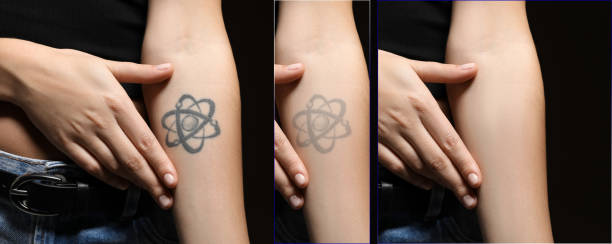 Laser tattoo removal image