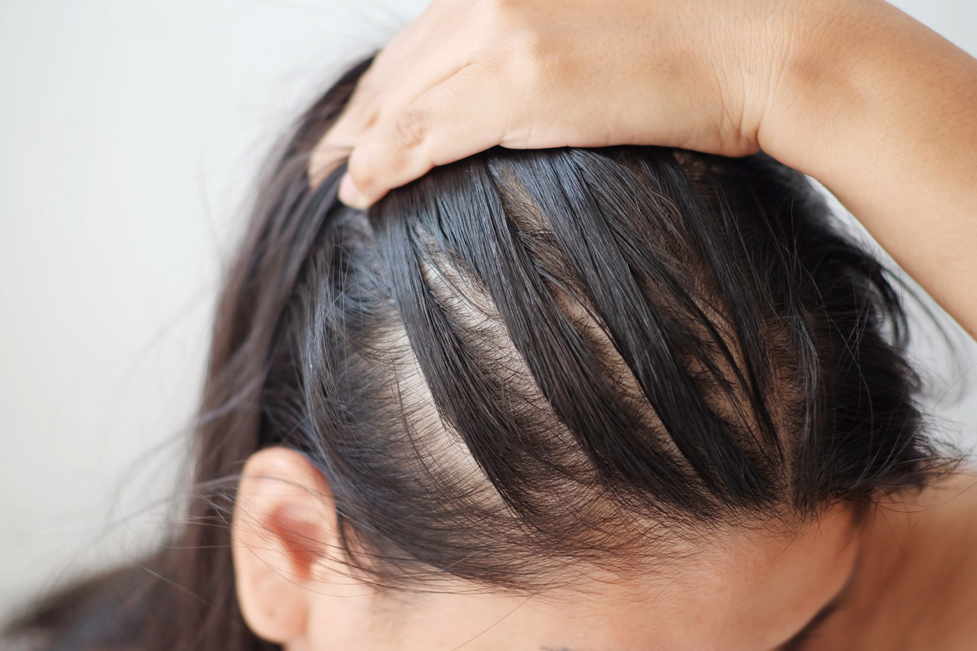 alopecia