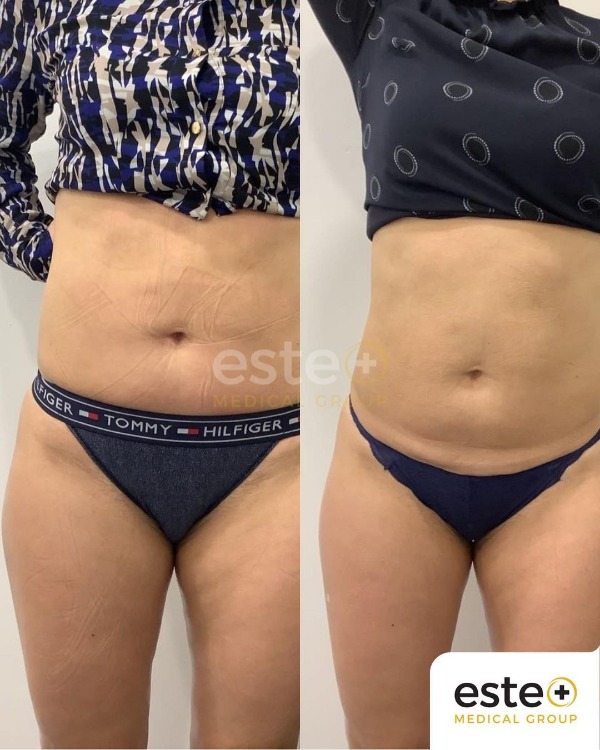 Skin Tightening Before After