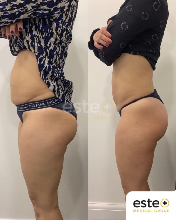 Skin Tightening Treatment Results