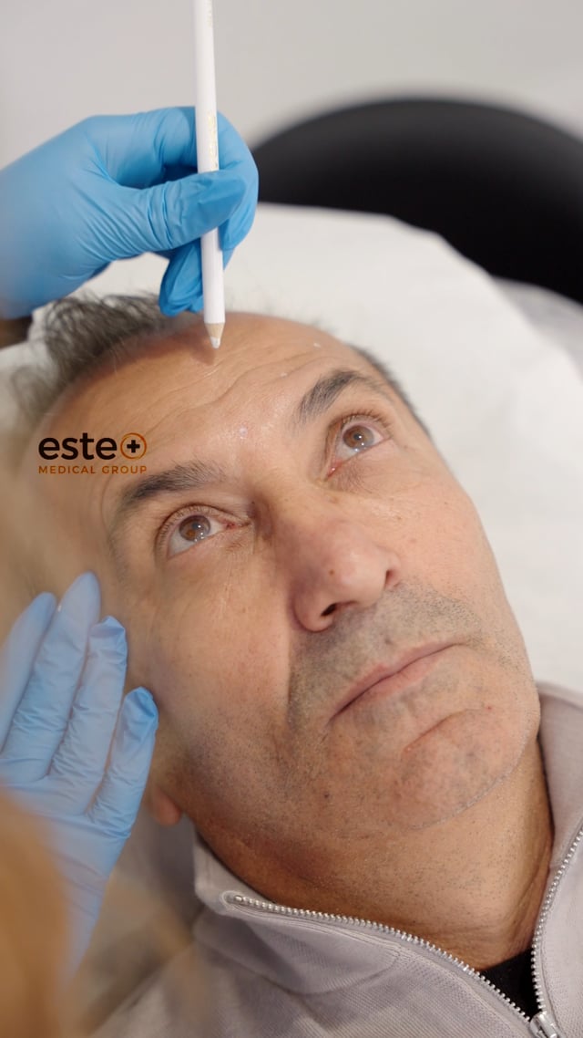 botox