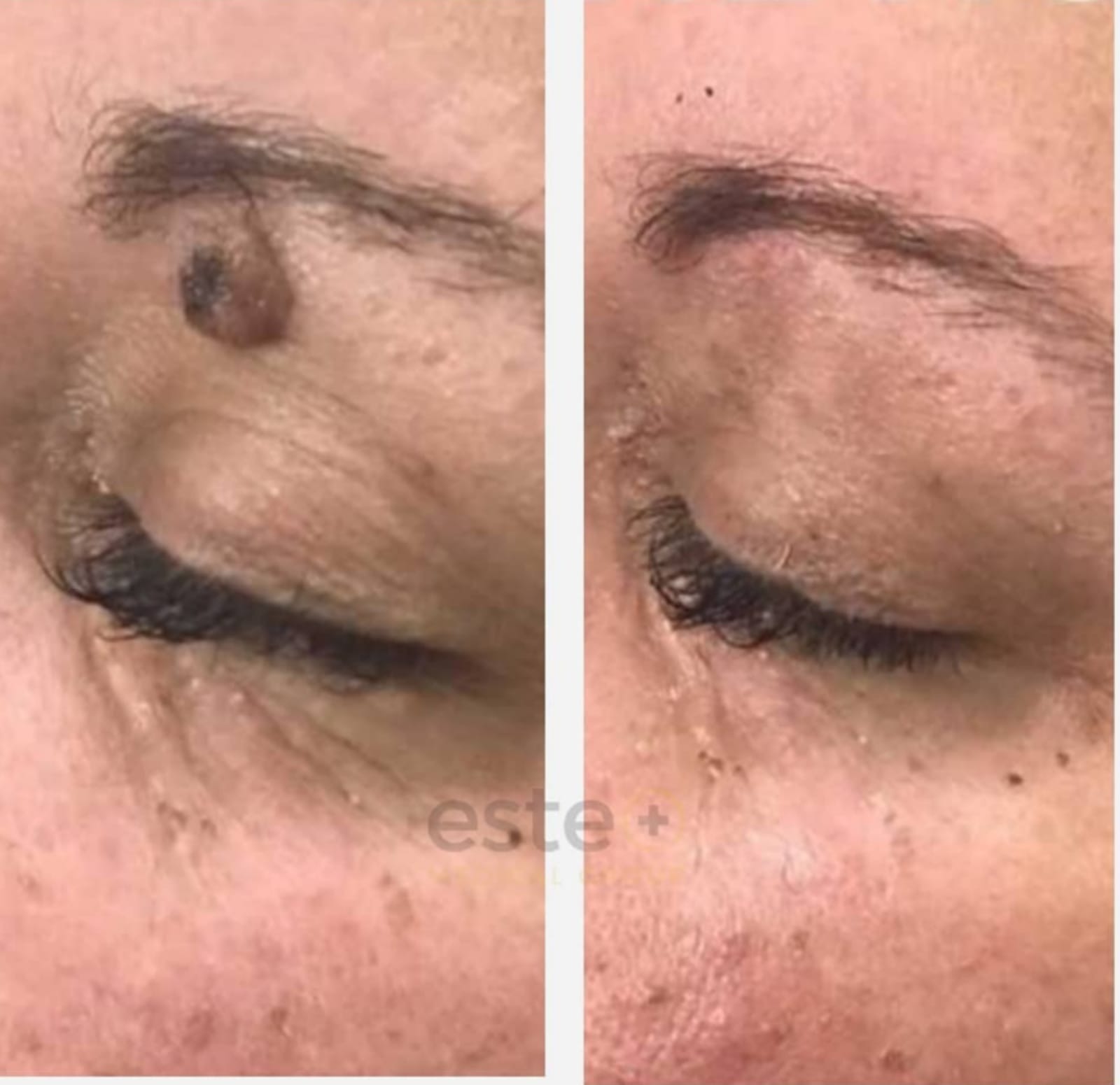 Lamprobe before after