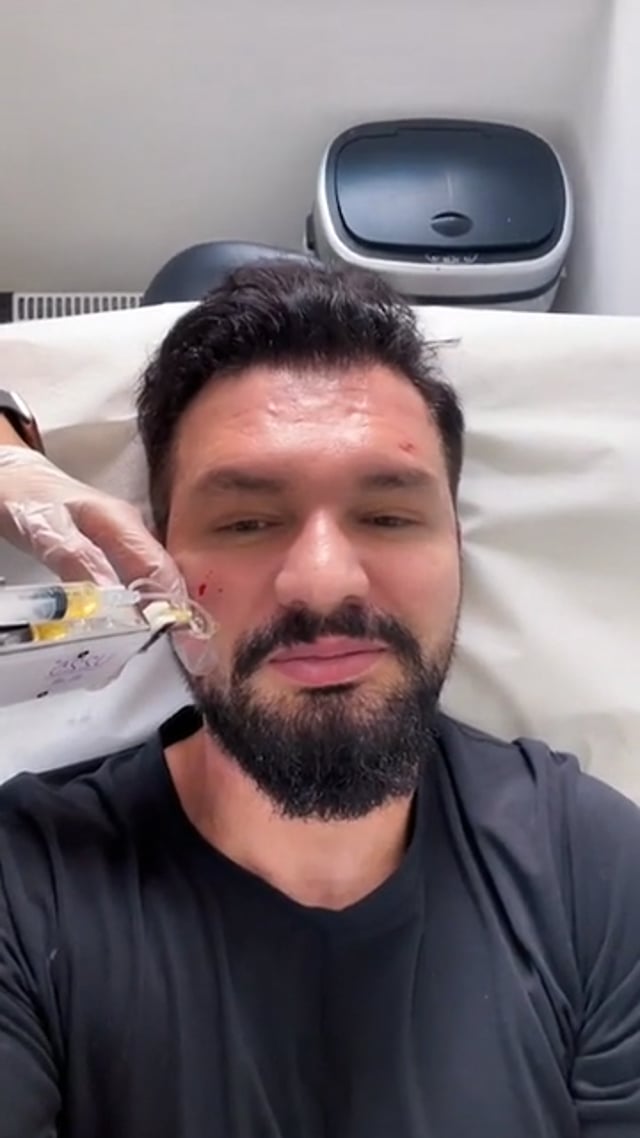 PRP facial