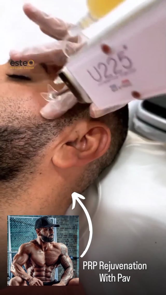 PRP facial