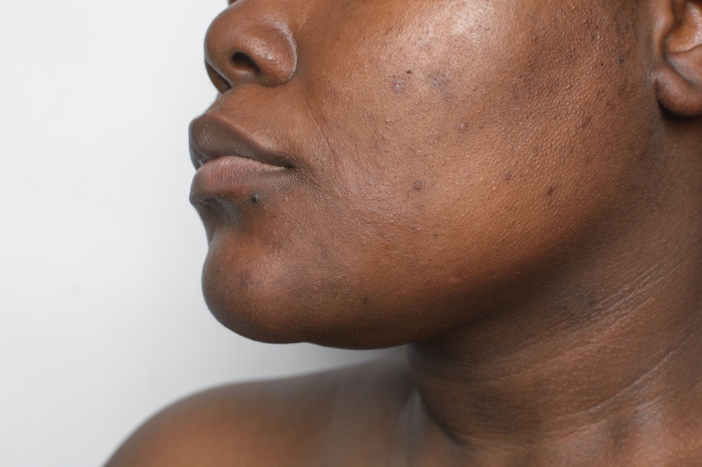 Skin pigmentation treatment Nairobi 