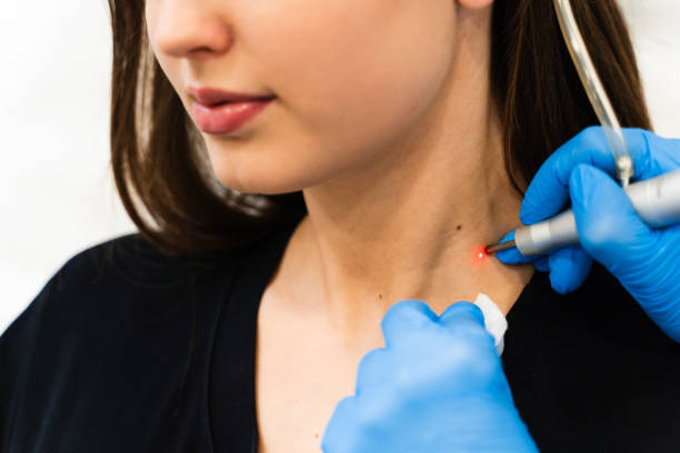 What makes FUE Hair Transplant Procedure the most Successful Technique?